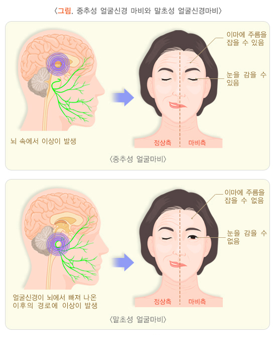  얼굴마비 (중추성 마비)