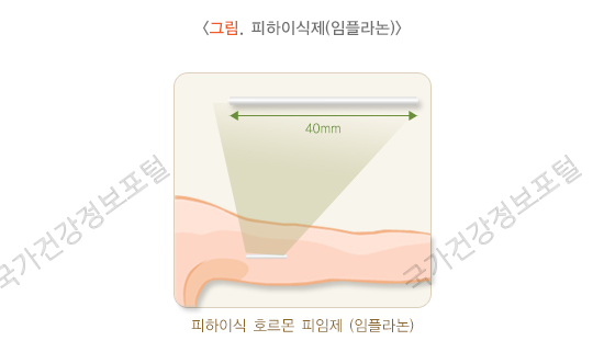 피하 이식제