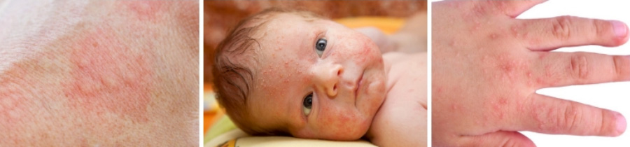 유아 습진으로 피부가 발갛게 발적이 되어 있고, 얼굴에 수포와 붉은 발진과 손등에 수포가 생기고 발적이 되어 있는 것을 찍은 사진