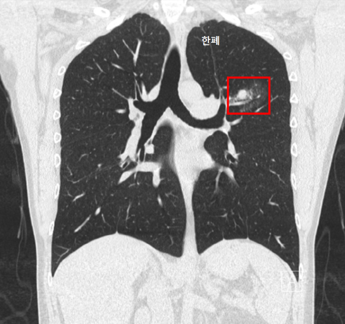 양성&amp;#44; 악성 폐결절 CT 사진