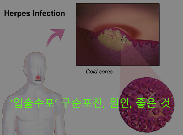 입술수포 구순포진, 원인, 좋은 것
