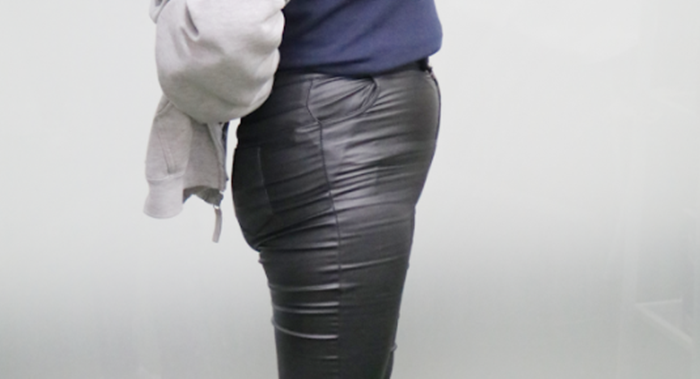 셀룰라이트까지 가능합니다. 궁둥이가 앙상함 5