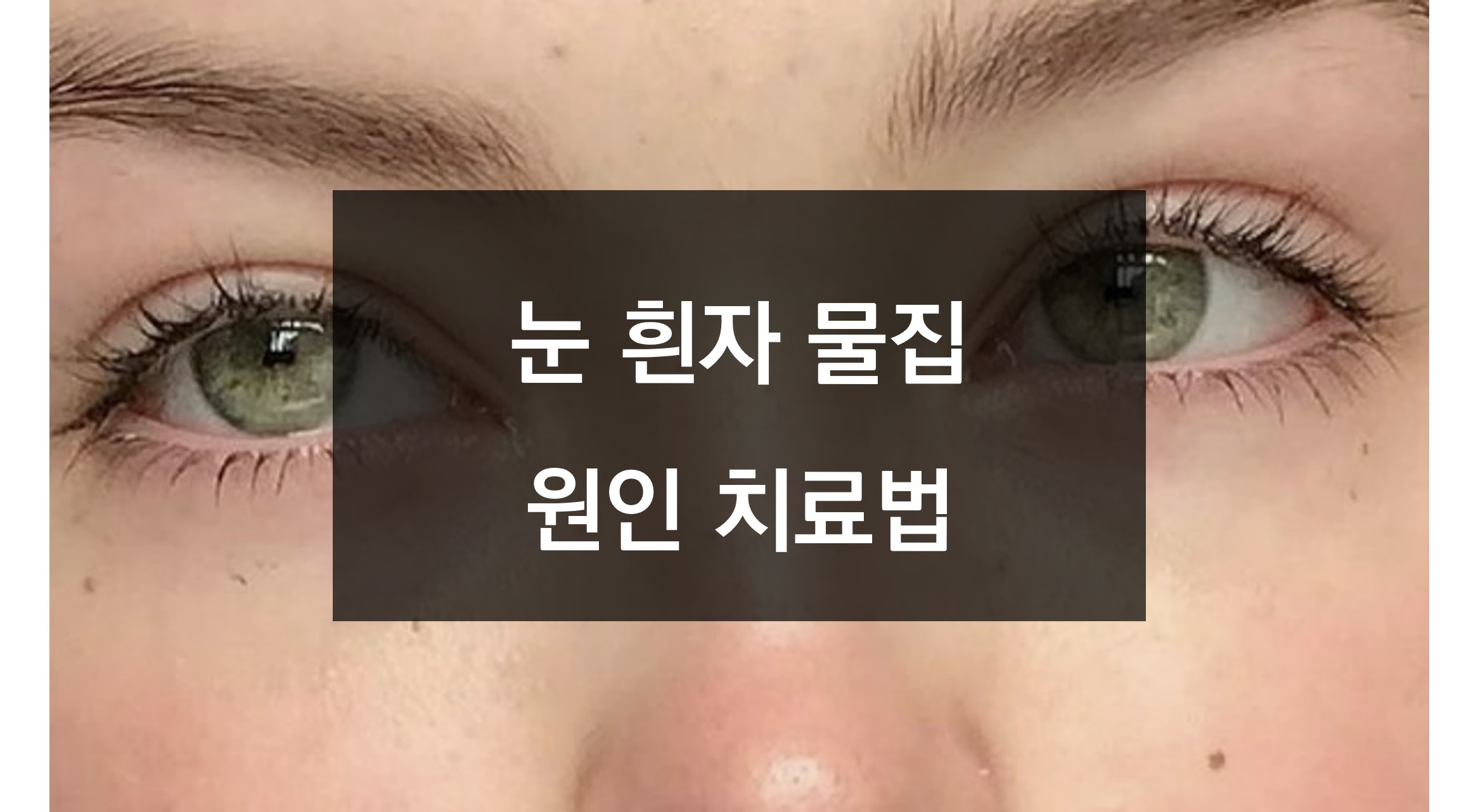 눈 흰자 물집