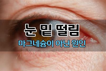  눈 떨림 현상 이유!! 단순 마그네슘 부족 때문일까?