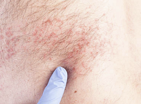 남성의 헤르페스 2형