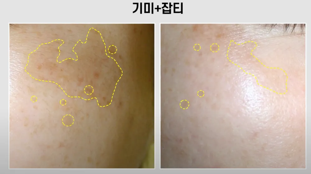 얼굴-기미-잡티-혼합형