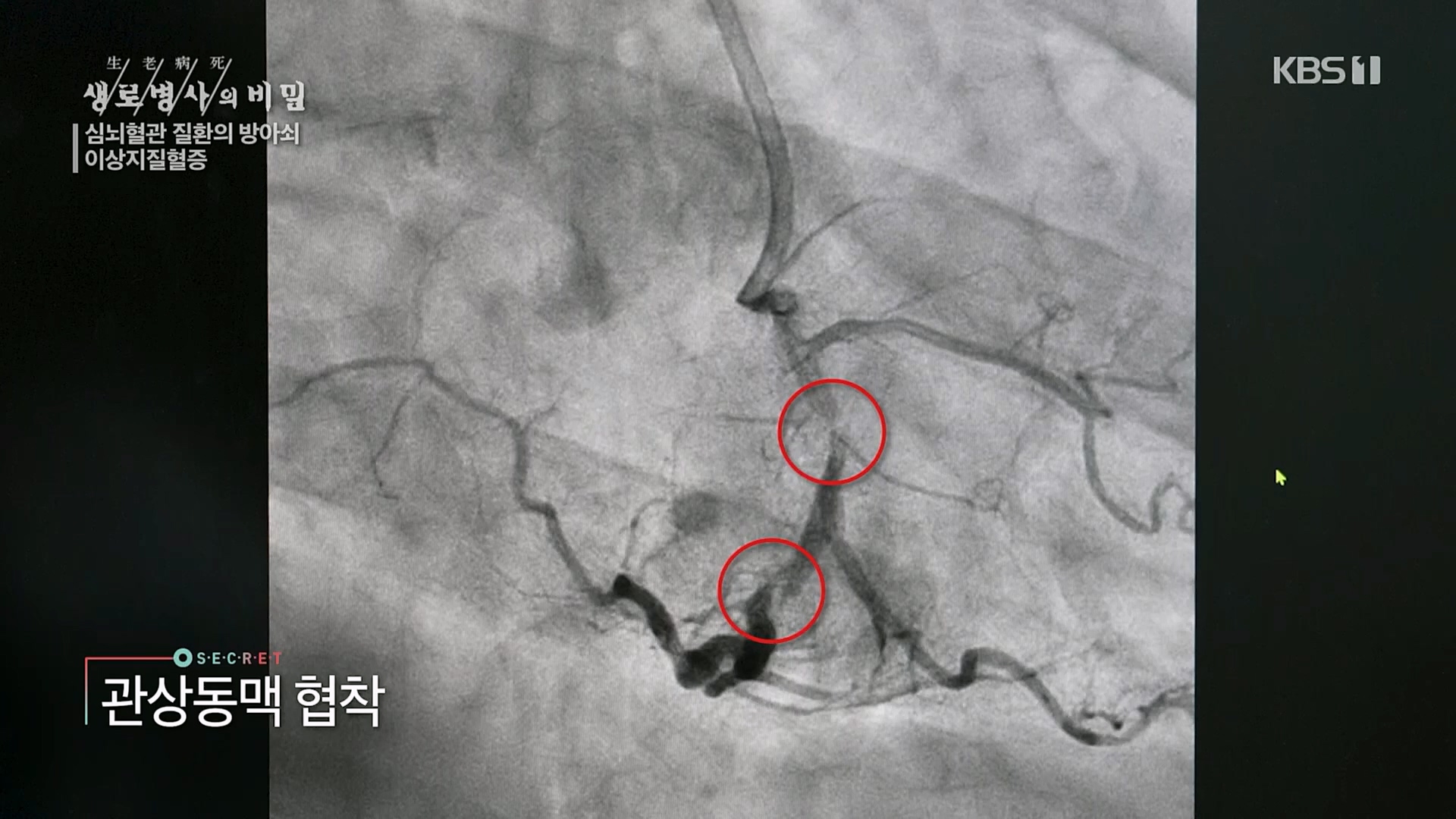 생로병사의 비밀.E862.230329p.H264-F1RST.mp4_20230330_203219.622.jpg