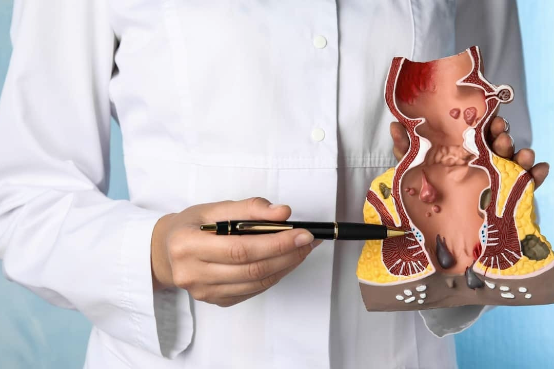 항문에서 피가 나는 이유