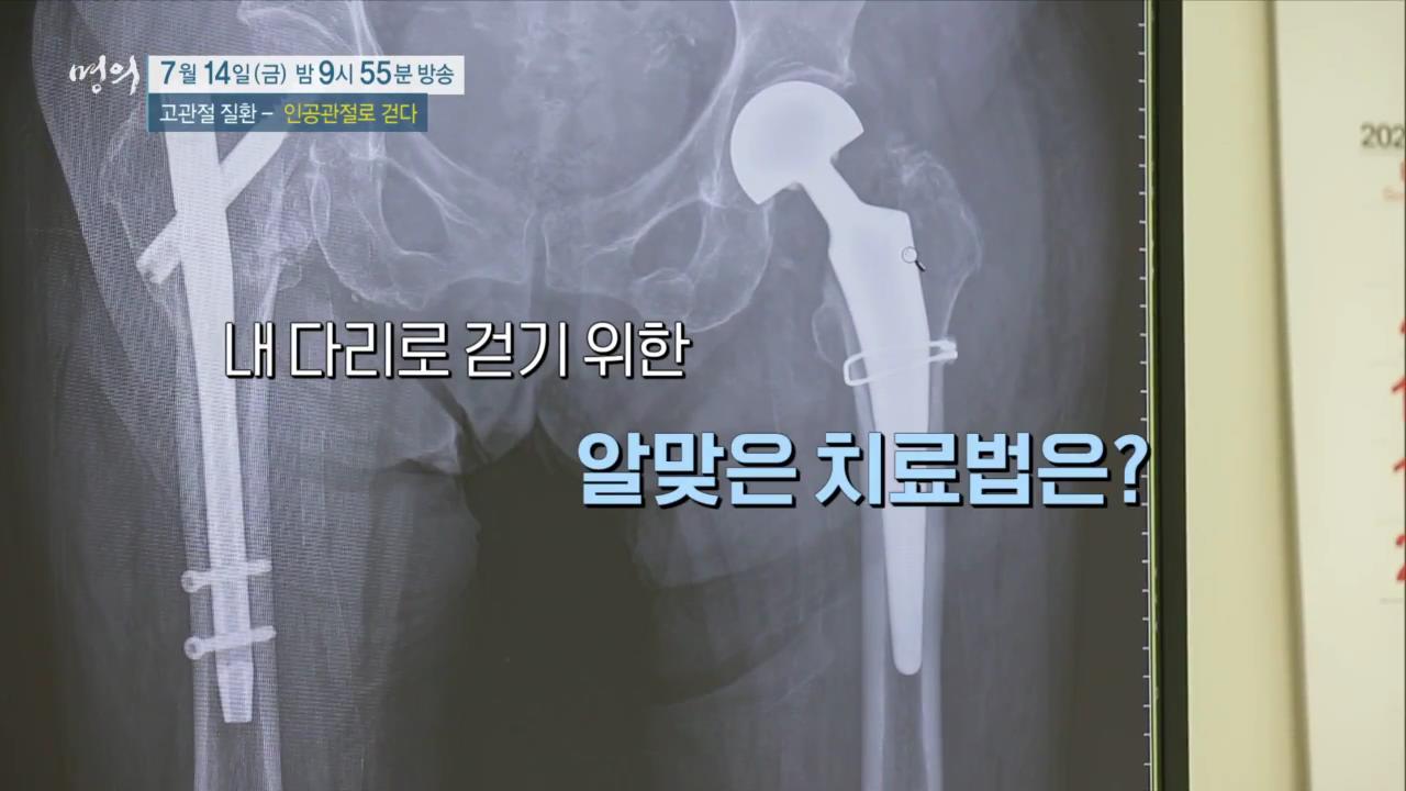 EBS 826회 명의 고관절 질환 - 인공관절로 걷다, 수술 후 합병증, 부작용 및 생활 관리, 퇴행성 관절염, 골절, 대퇴골두무혈성 괴사 치료 방법 강북 삼성병원 박윤수 박재형 교수