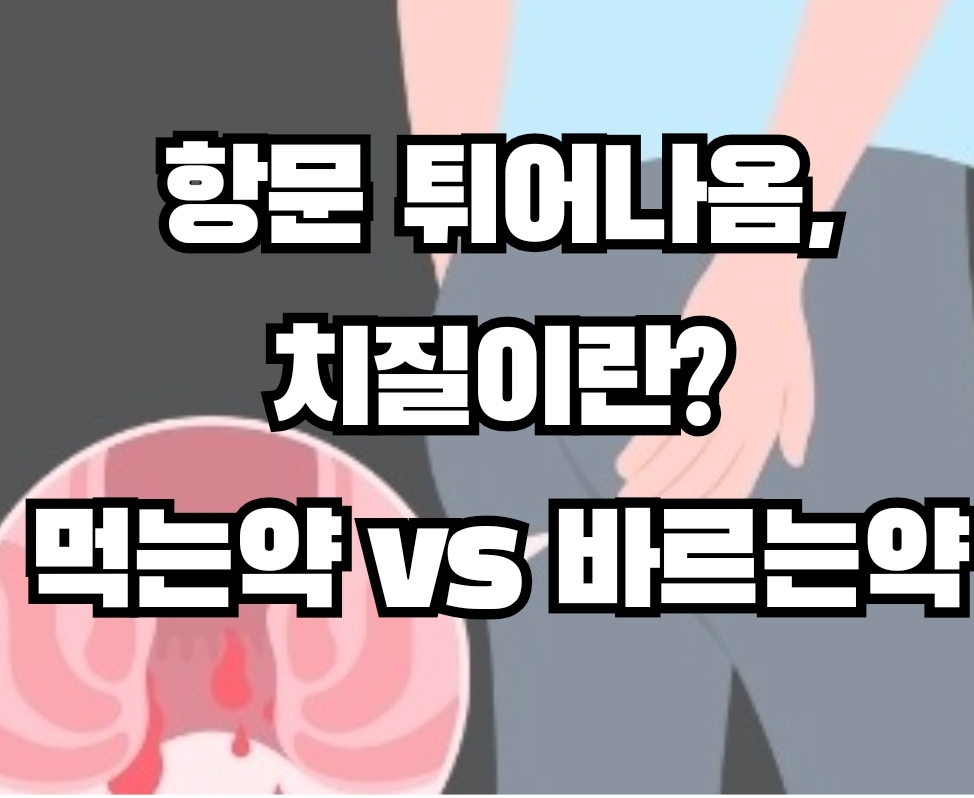  치질약 종류)항문 튀어나옴에도 치질약이 효과가 있을까?먹는 치질약, 치질연고 종류, 치질약물치료