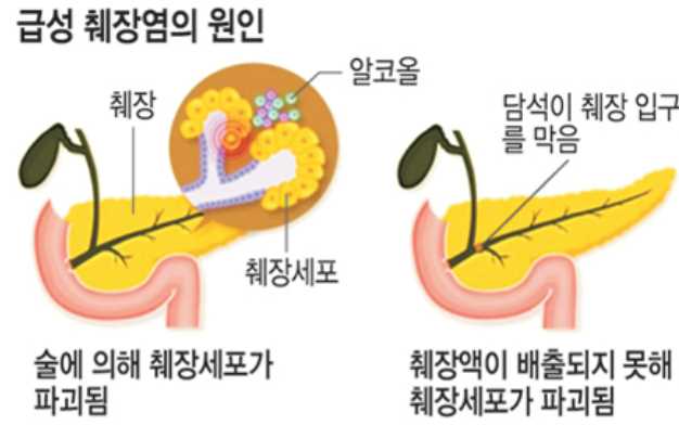 오른쪽 갈비뼈 아래 통증 - 췌장염