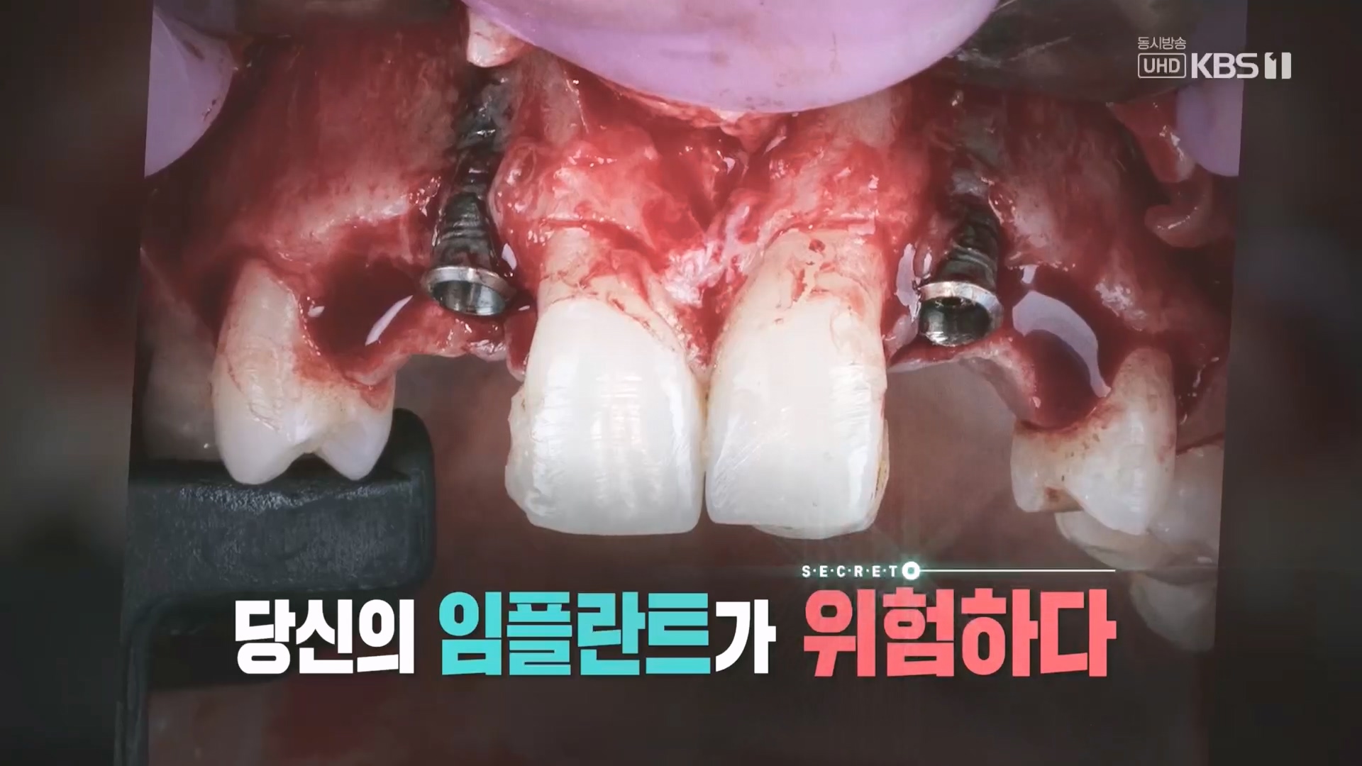 생로병사의 비밀.E890.231213p.H264-F1RST.mp4_20231214_195014.754.jpg
