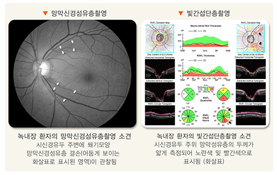 녹내장-증상-설명하는-사진