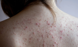 Understanding the Causes and Management of Body Acne.