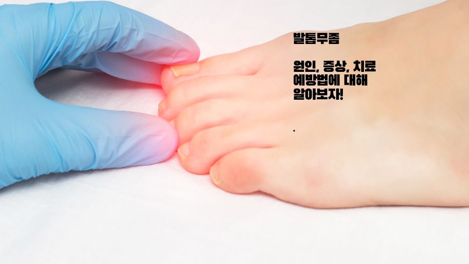발톱무좀 없애는 방법, 치료 예방법 원인 자가진단 테스트에 대해서 알아보자!