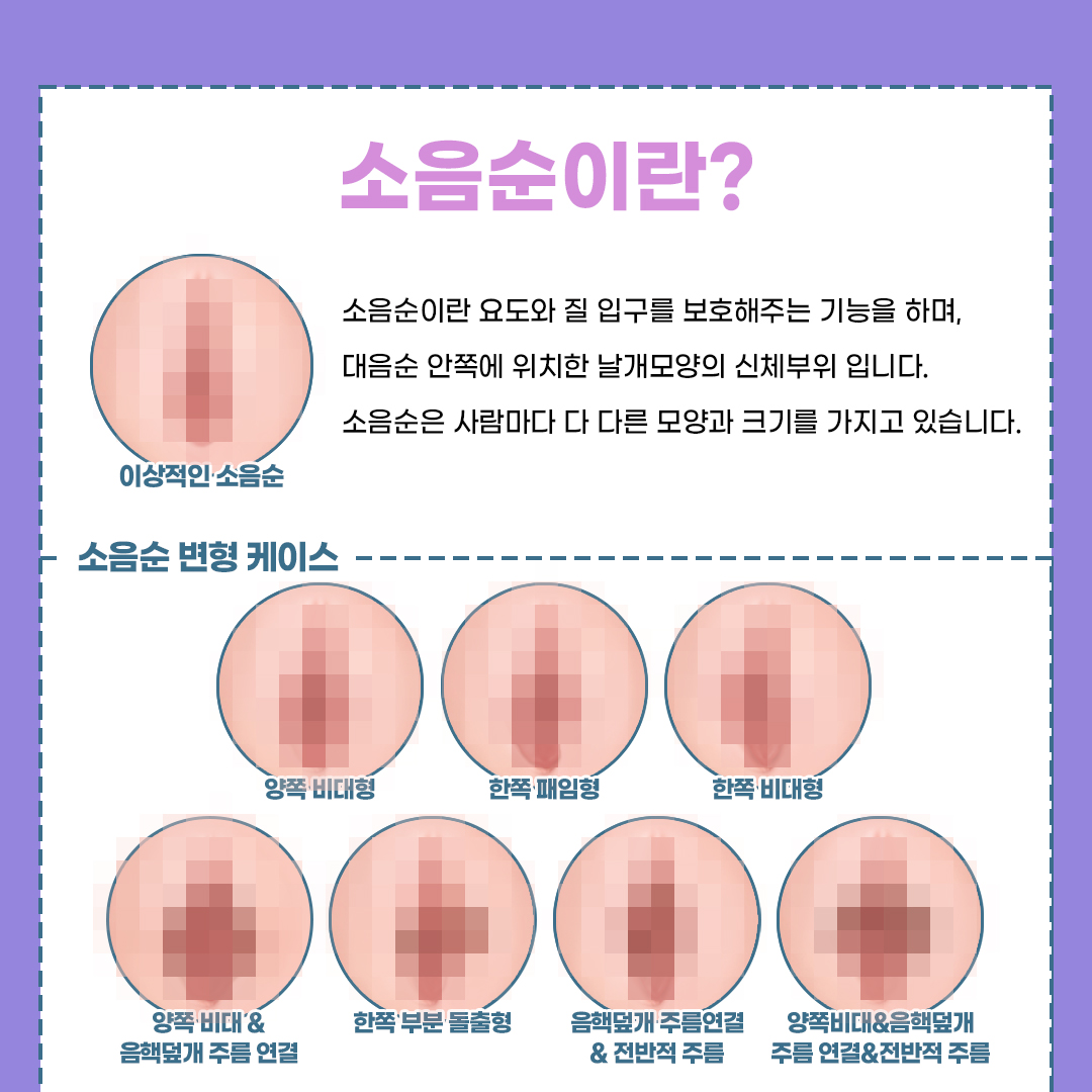 죽전역산부인과 소음순늘어남 레이저 수술이 답인가요?