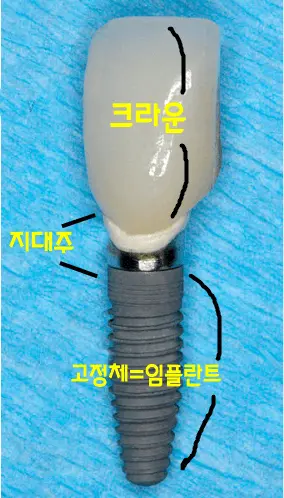 임플란트-구조-재료