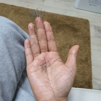 두통 수지침 편두통 혈자리_4
