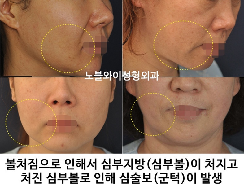  안면거상술 부작용 납작해져버린 얼굴이?