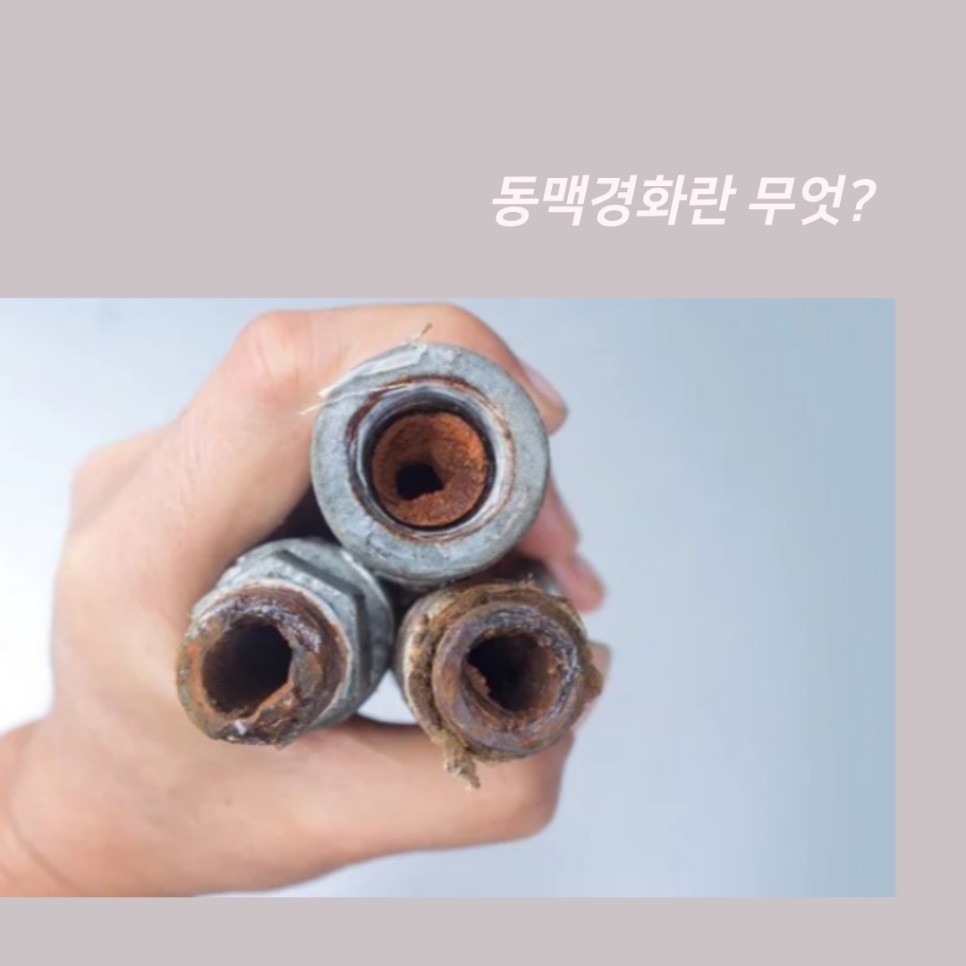 검사와 치료(죽상경화증) 동맥경화증상