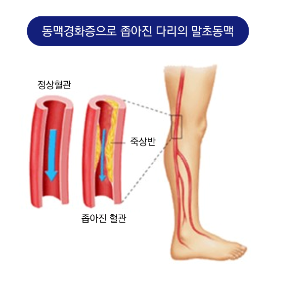 말초동맥질환