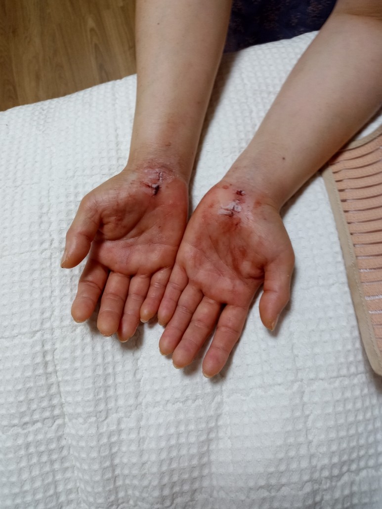 증상과 수술 후 리뷰 양손목터널증후군