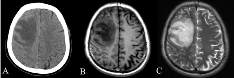 머리-CT-MRI-사진