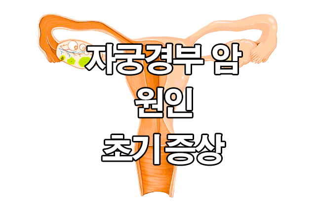  자궁경부암 초기증상, 원인 : 전조증상, 바이러스