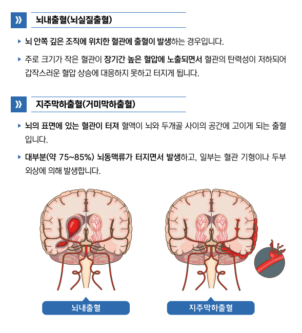 출혈성 뇌졸증