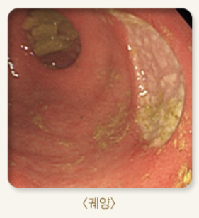 십이지장 궤양 증상 1