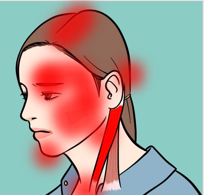 흉쇄유돌근(목빗근) 통증, 기능, 해부, 턱관절과의 관련성 그 모든 것