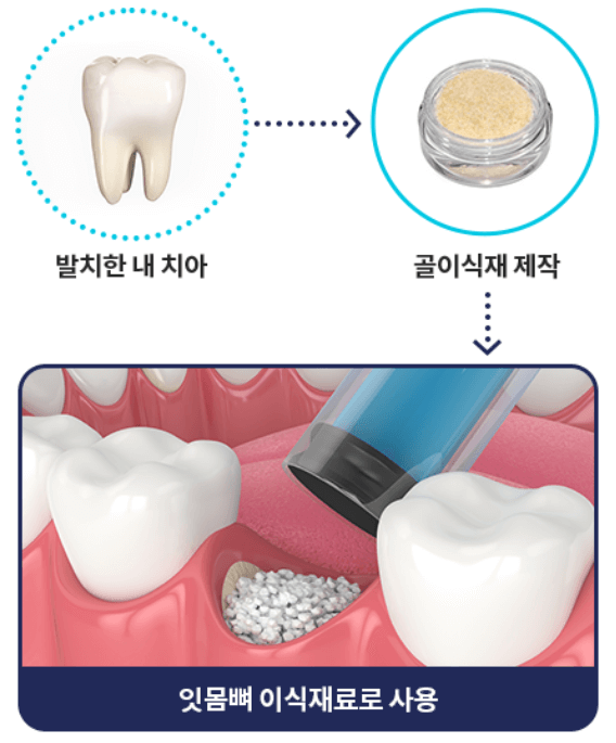 임플란트 비용 무상지원 대상 신청방법