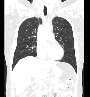 Lung CT 관상면