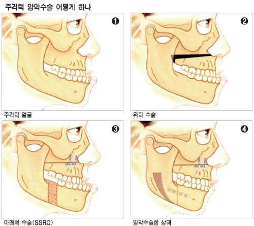 양악수술 과정 이미지