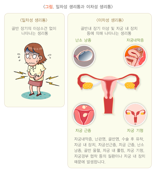  생리통