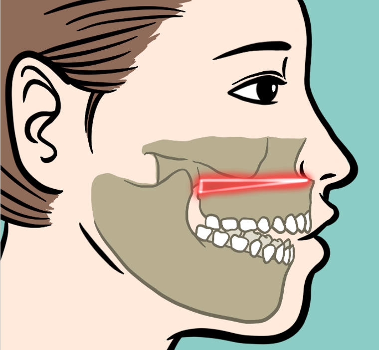 턱 퇴행성 관절염 치료법과 턱관절 스플린트 3종류 비교