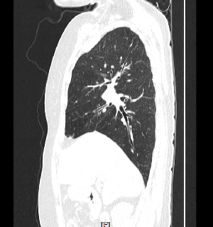 Lung CT 시상면
