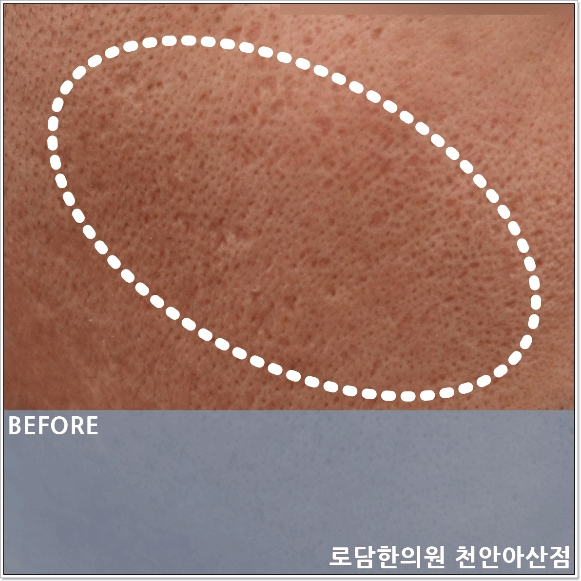 여드름 흉터 제거 로담한의원 새살침 코라테라피 치료 과정