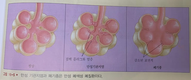 만성폐쇄성폐질환-COPD-원인-치료-증상-주의사항