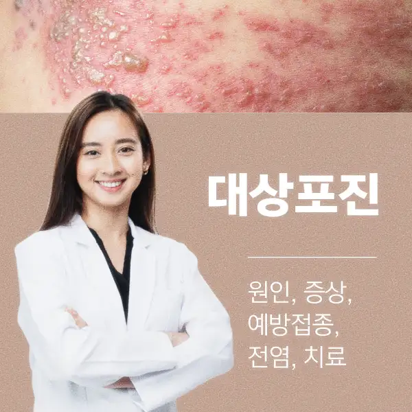대상포진 원인, 증상, 예방접종, 전염, 치료