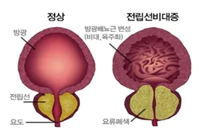 전립선비대증 치료약 부작용