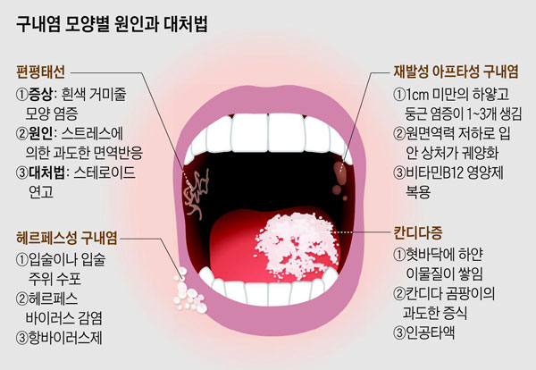 혀 통증 원인 혓바늘이 돋는 이유 혀 끝, 옆, 밑, 안쪽, 뿌리