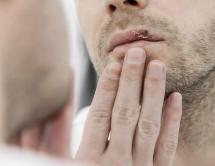 남성의 헤르페스 2형