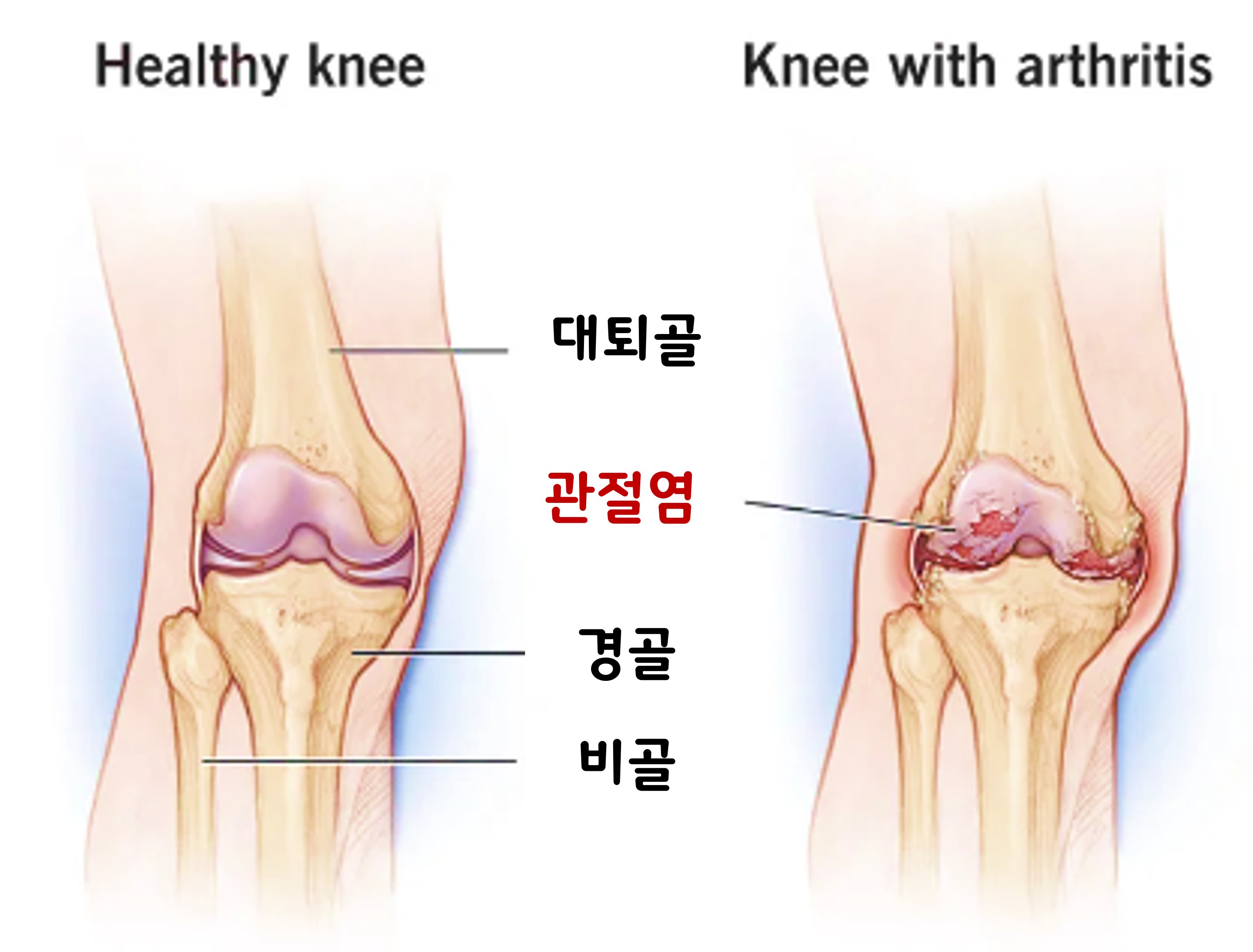 무릎관절의 구조와 관절염