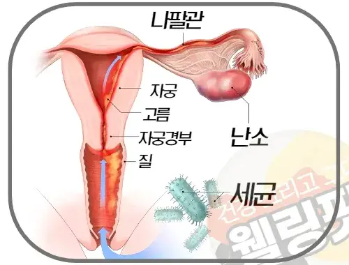 골반염은-질-안쪽-자궁에서-발생한-세균성-염증-질환-입니다.