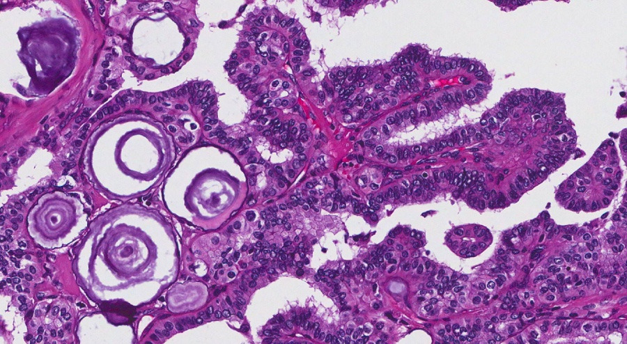 Psammoma body