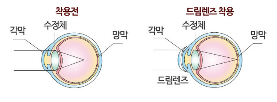 드림렌즈 가격 효과 착용기간 후기