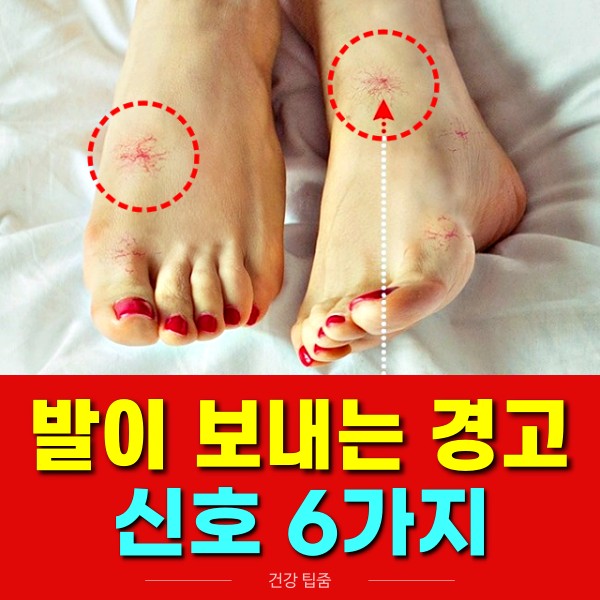 발이 보내는 경고 신호 6가지, 발붓기, 색소침착, 거미혈관, 당뇨발, 다리가 무거운 증상