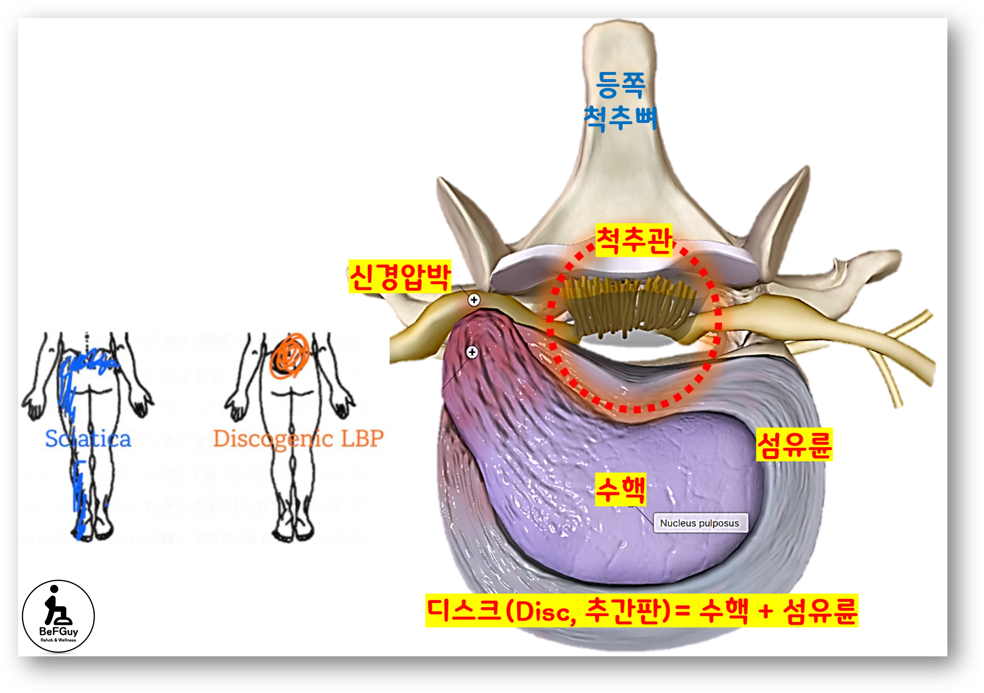 허리 디스크