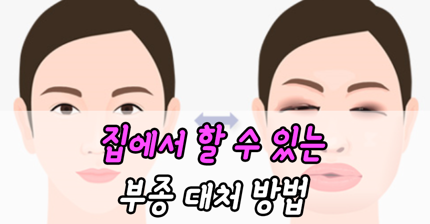  집에서 할 수 있는 부종 대처 방법